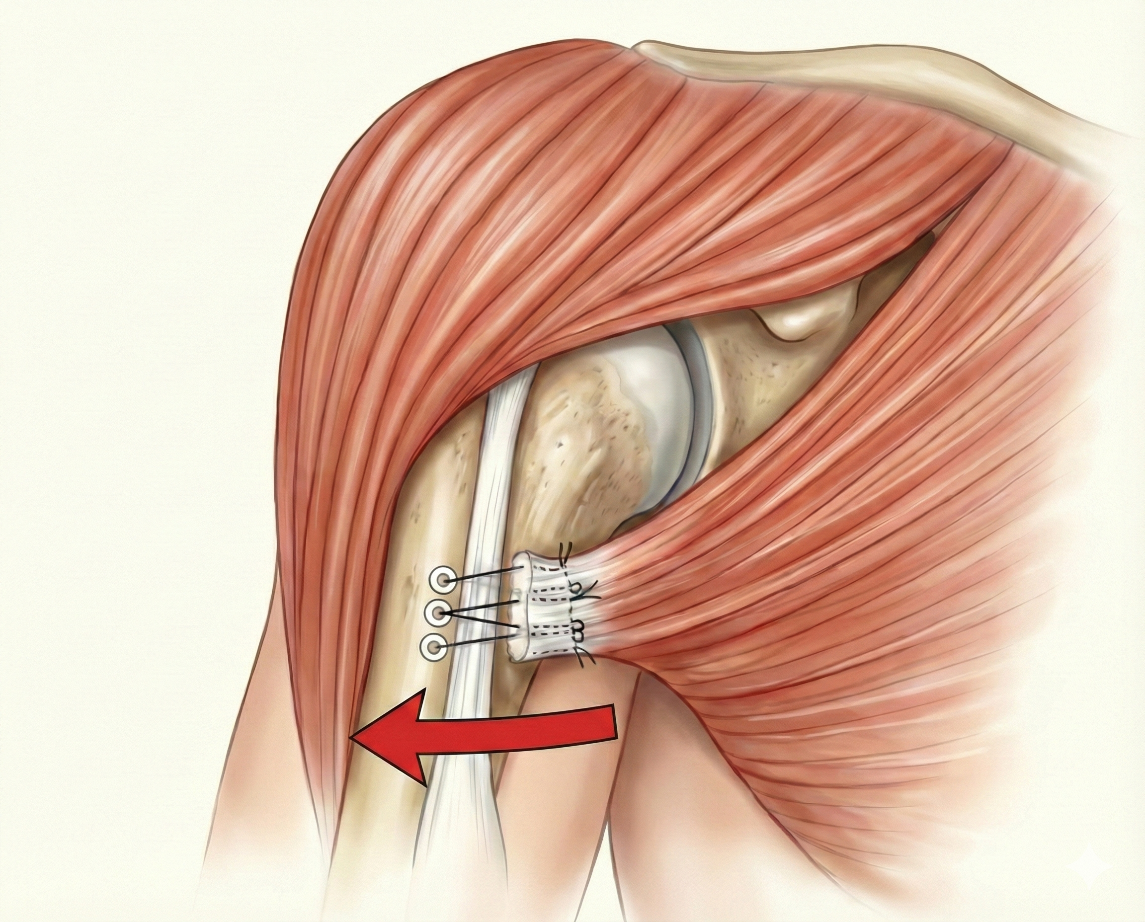 Illustration of shoulder anatomy showing muscles, tendons, and the shoulder blade. A tear in the pectoralis major tendon is being repaired with suture with a red arrow indicating the direction of that repair. - Dr. Kevin Wall, Richmond, VA