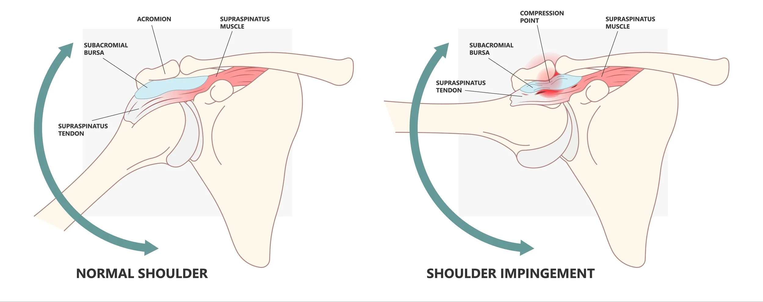 Diagram comparing normal shoulder anatomy with shoulder impingement. Left side shows a normal shoulder with labeled subacromial bursa, acromion, supraspinatus muscle, and supraspinatus tendon. Right side shows shoulder impingement with inflammation and pain at the subacromial bursa, supraspinatus tendon, and a compression point.