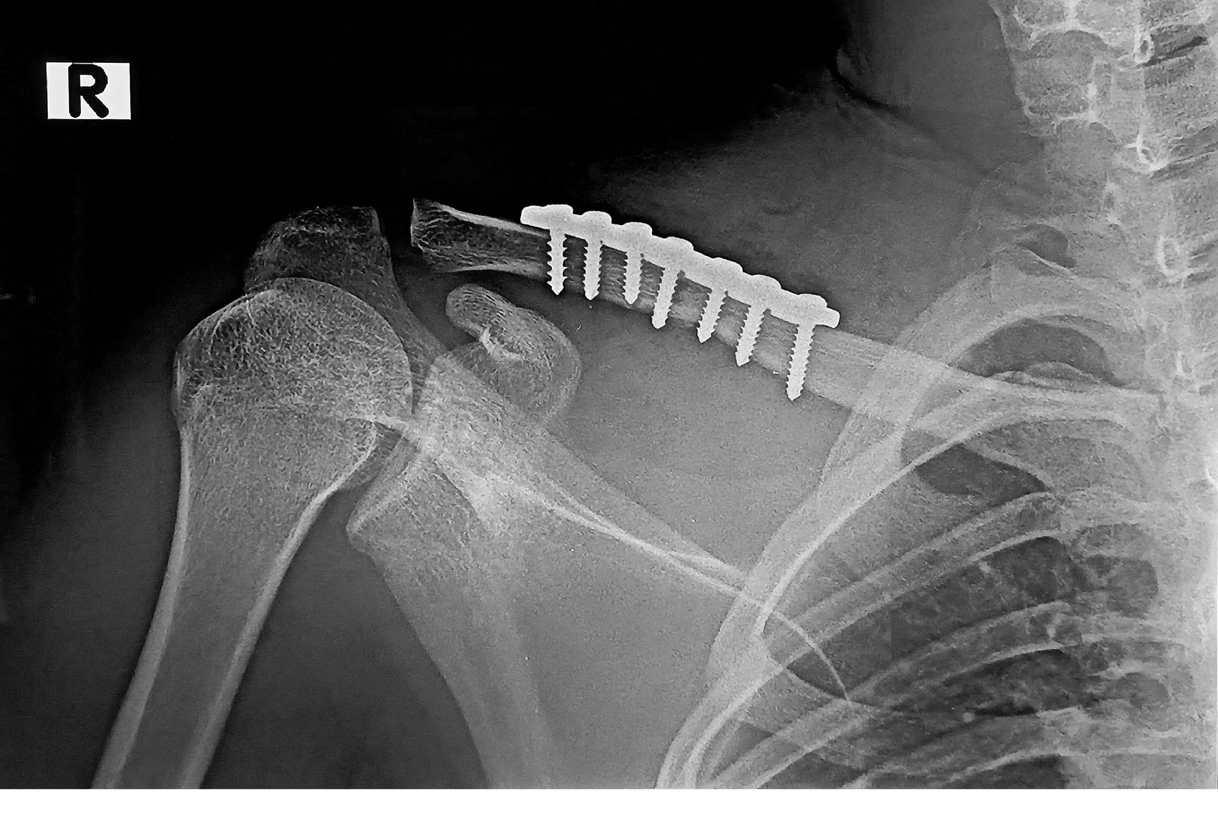 X-ray image of a shoulder with a metal screw and plate fixation for a broken clavicle. - Dr. Kevin Wall, Richmond, VA