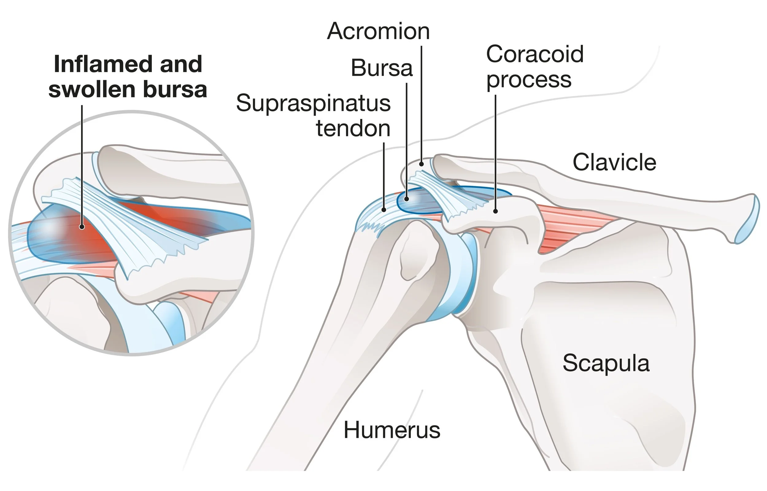 Diagram showing inflamed and swollen bursa in a shoulder, with labels for acromion, supraspinatus tendon, bursa, coracoid process, clavicle, scapula, humerus, and highlighted inflamed bursa. - Dr. Kevin Wall, Richmond, VA