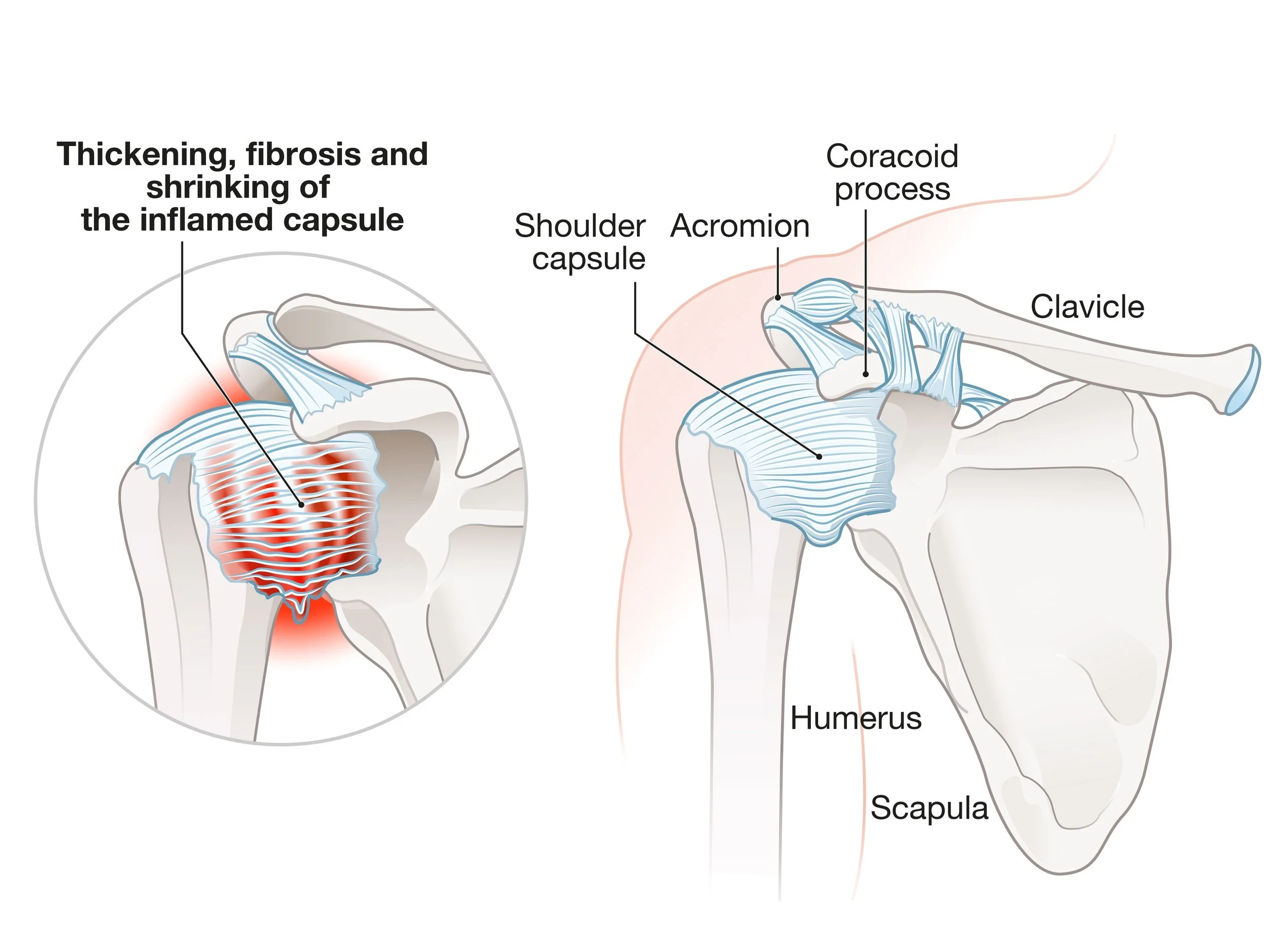Diagram showing shoulder anatomy with labels for shoulder capsule, acromion, coracoid process, clavicle, humerus, scapula, and shoulder capsule thickening, fibrosis, and shrinking. - Dr. Kevin Wall, Richmond, VA