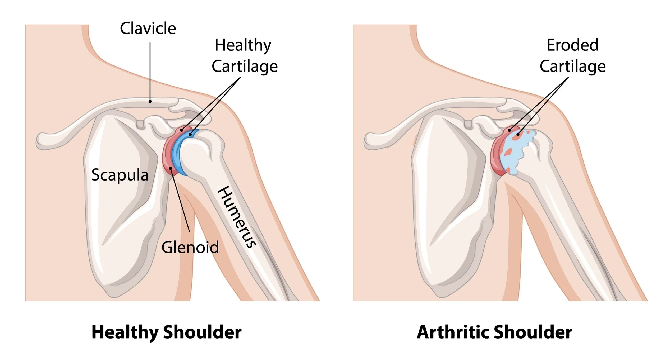 Comparison of healthy and arthritic shoulder joints, showing a healthy shoulder with healthy cartilage and an arthritic shoulder with eroded cartilage.  - Dr. Kevin Wall, Richmond, VA