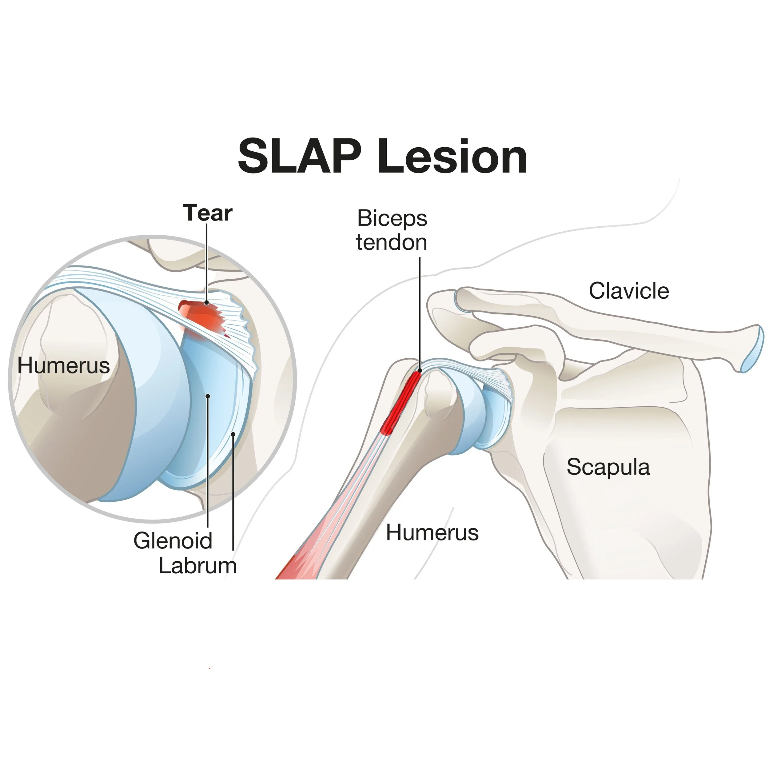 Diagram of a scapular SLAP lesion showing tear in the superior labrum, with labels of humerus, glenoid labrum, biceps tendon, clavicle, scapula, and humerus.  - Dr. Kevin Wall, Richmond, VA