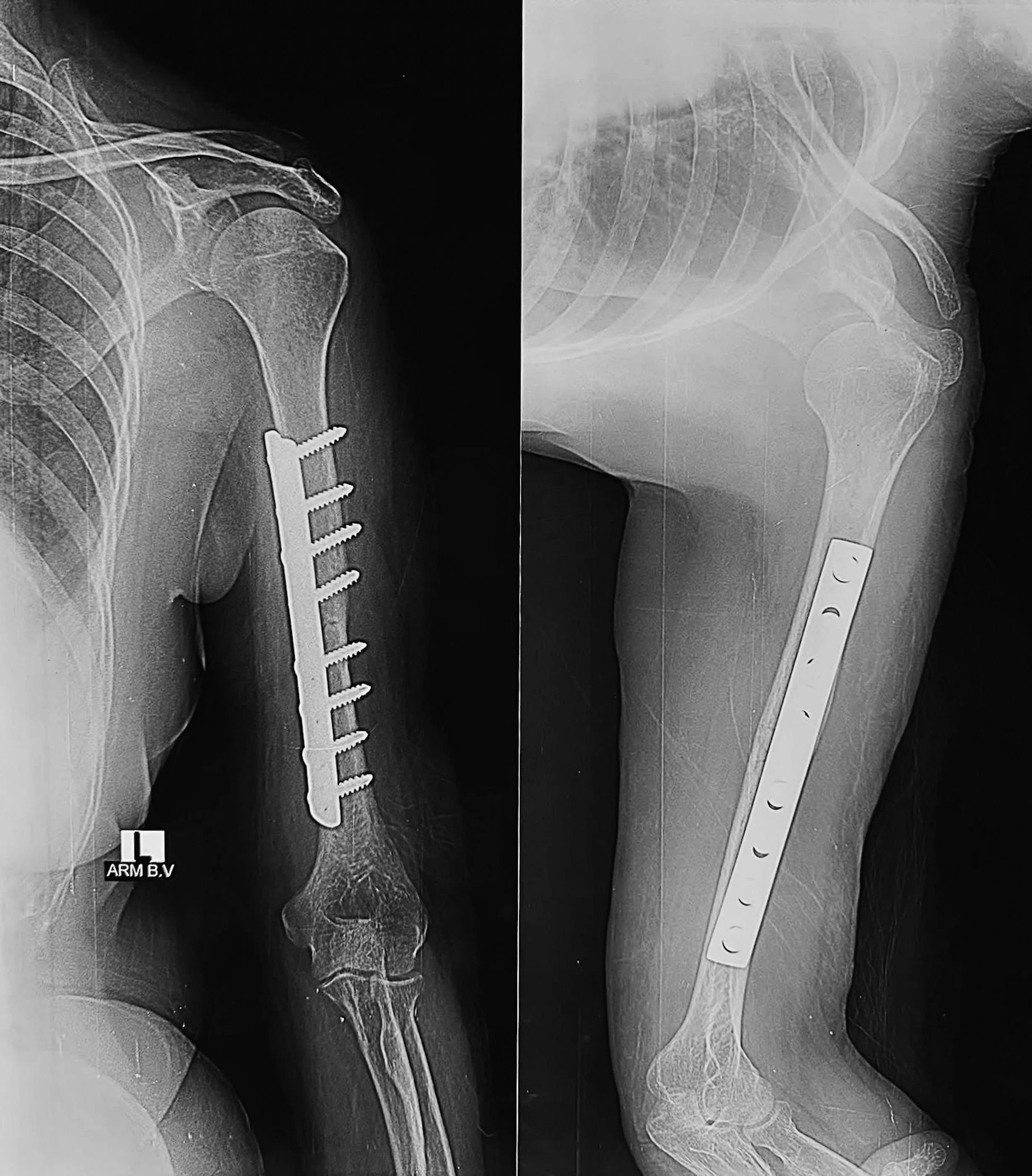 X-ray image showing a humerus with surgical plates and screws indicating a surgical repair of a fracture. - Dr. Kevin Wall, Richmond, VA