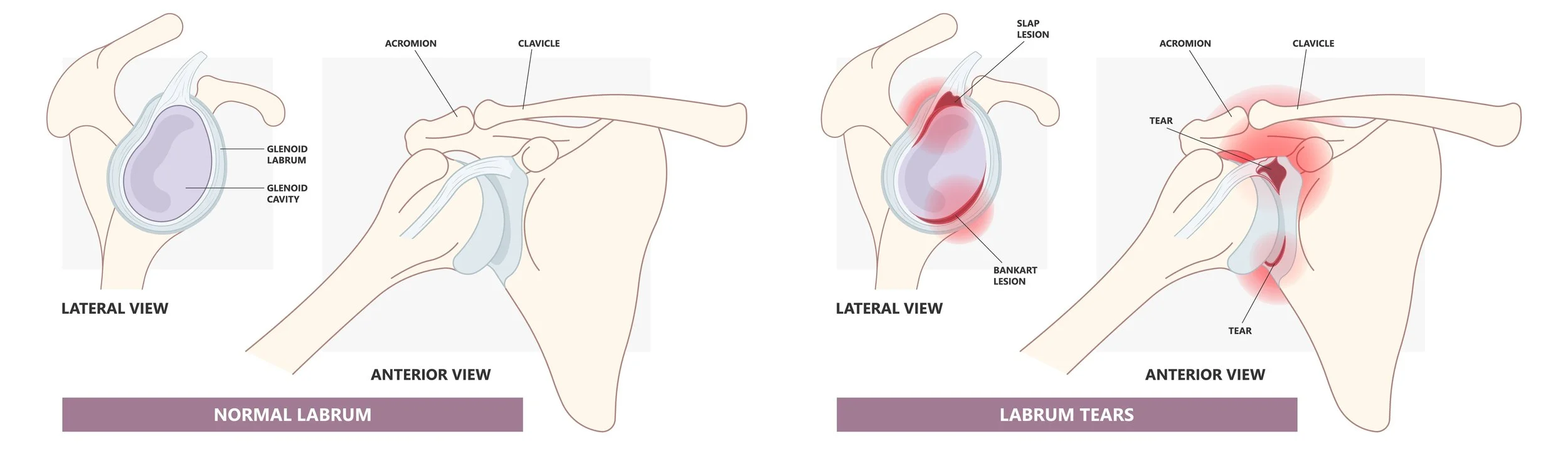 An illustration comparing a normal shoulder labrum to a labrum tear. The left side shows the healthy labrum with labels for glenoid labrum and glenoid cavity. The right side shows a torn labrum with red areas indicating injury, including slap and bankart lesions, and tears at the shoulder socket and attachment points.