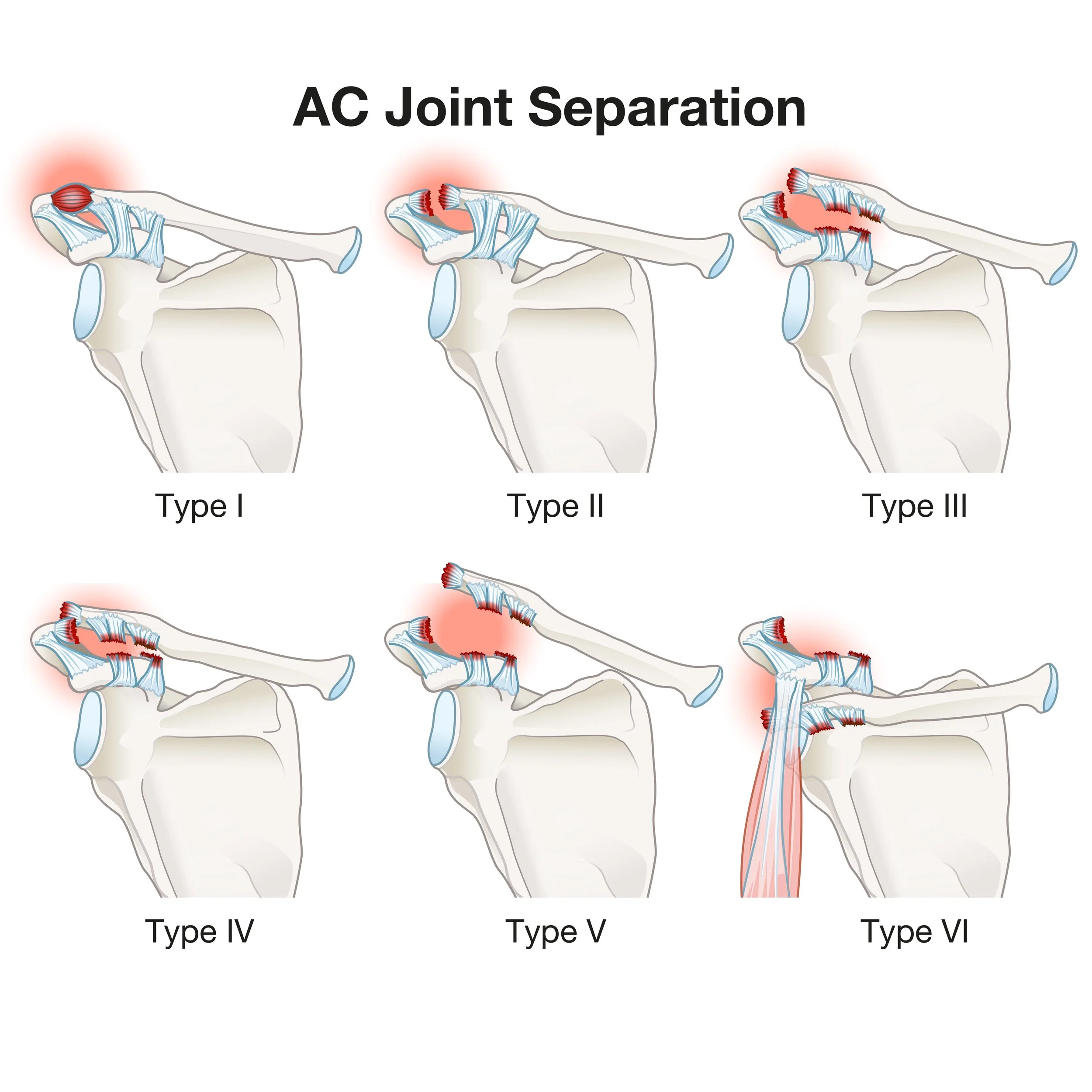 Illustration showing six types of acromioclavicular (AC) joint separation, labeled Type I through Type VI, with diagrams depicting varying degrees of ligament damage and displacement of the clavicle. - Dr. Kevin Wall, Richmond, VA
