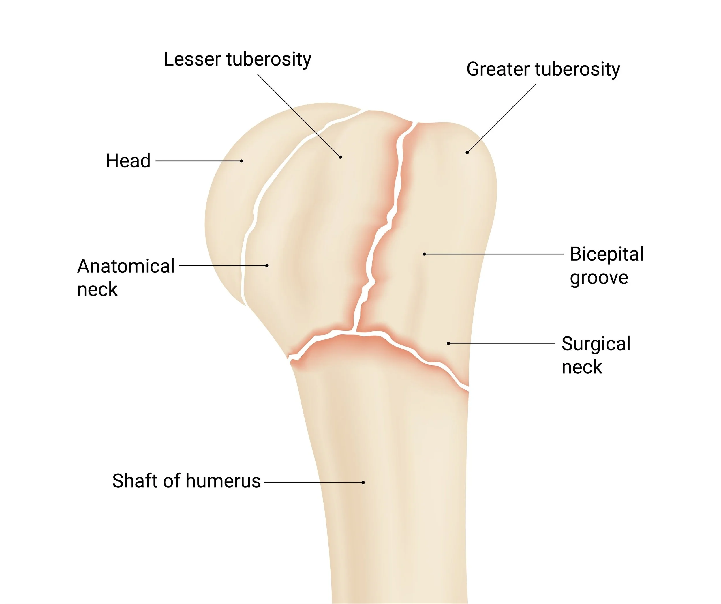 Diagram of a human upper arm showing a fractured humerus bone with labels for head, lesser and greater tuberosity, anatomical neck, bicepital groove, surgical neck, and shaft of humerus. - Dr. Kevin Wall, Richmond, VA
