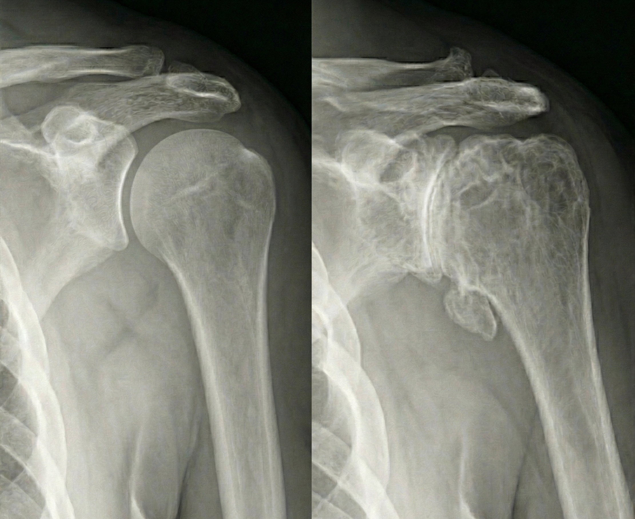 Comparison of healthy and arthritic shoulder xrays (radiographs), showing a healthy shoulder with healthy cartilage and an arthritic shoulder with eroded cartilage and bone spurs (osteophytes).  - Dr. Kevin Wall, Richmond, VA