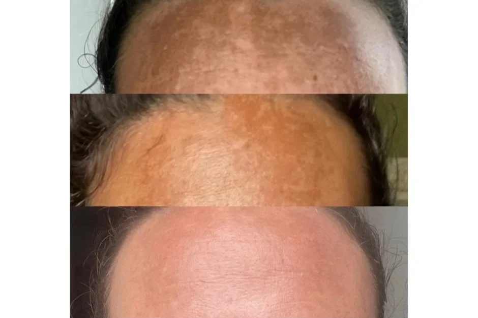 Hyperpigmentation Solutions