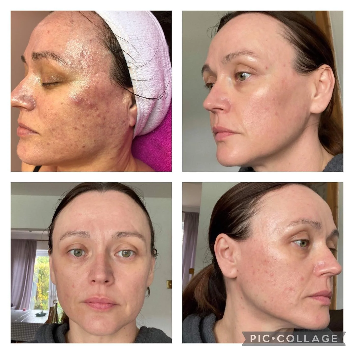 PURE Peel_Four_Treatments.jpg