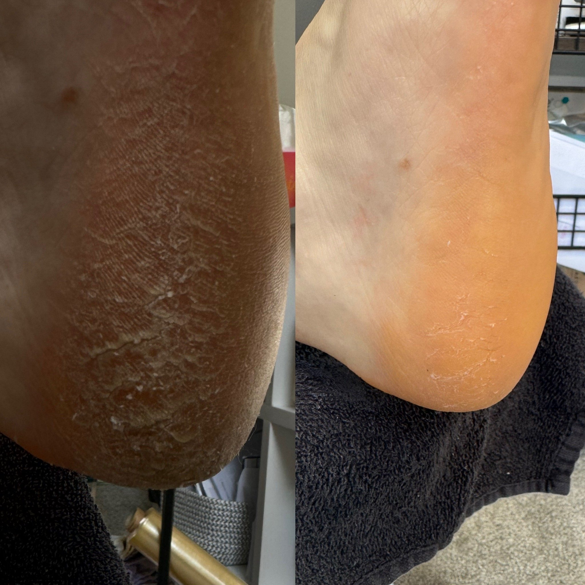 Comparison of rough, dry skin on the left side and smooth, moisturized skin on the right side of a heel.