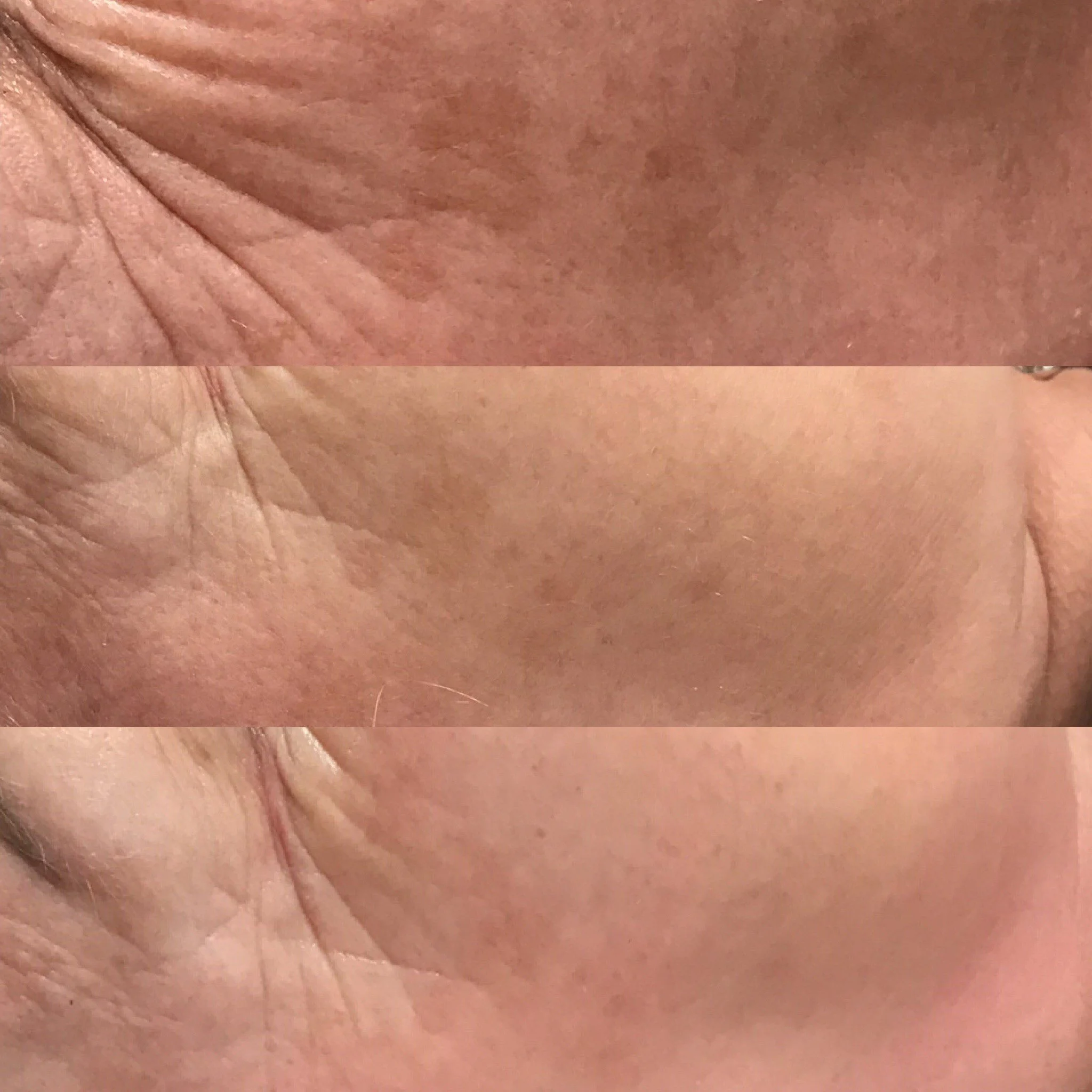 GLOWPeelAfter3Treatments.jpg