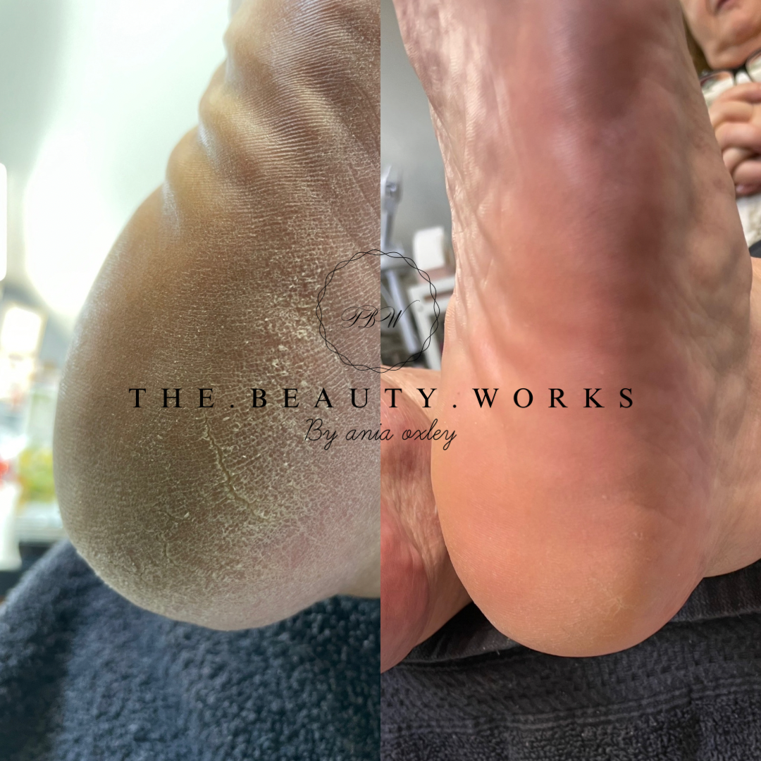 Close-up of a foot's heel before and after a skincare treatment, showing rough, dry skin on the left and smooth, moisturized skin on the right.