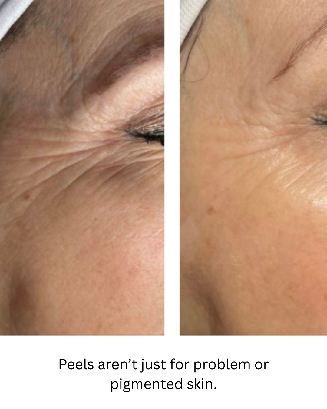 Peels aren’t just for problem or pigmented skin.png