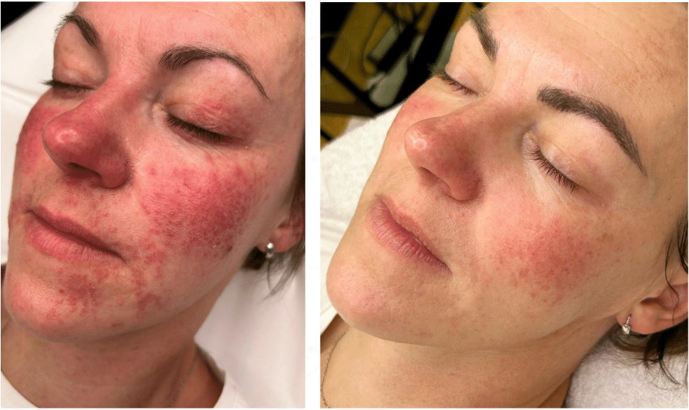 Rosacea