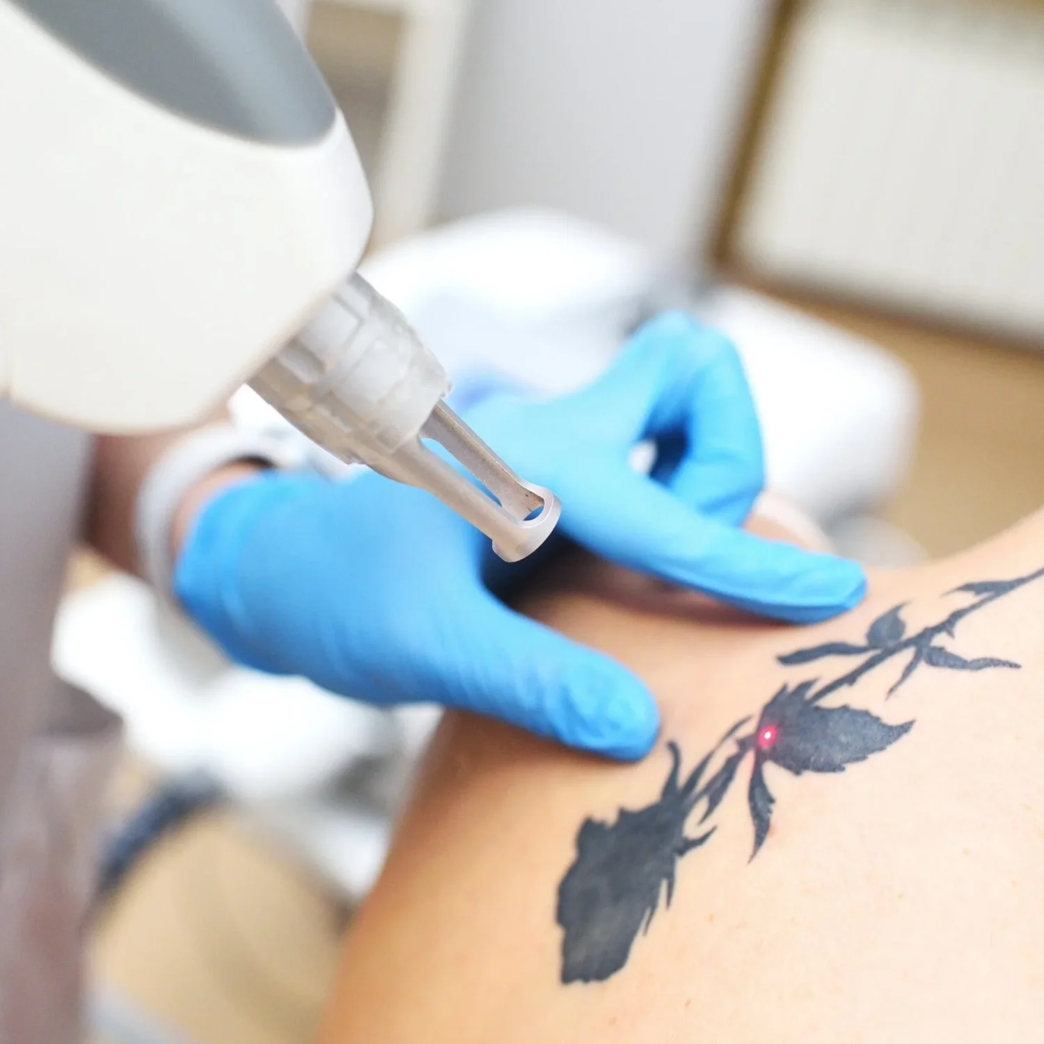 Tattoo verwijderen, tattoo weglaseren, laser tattoo removal