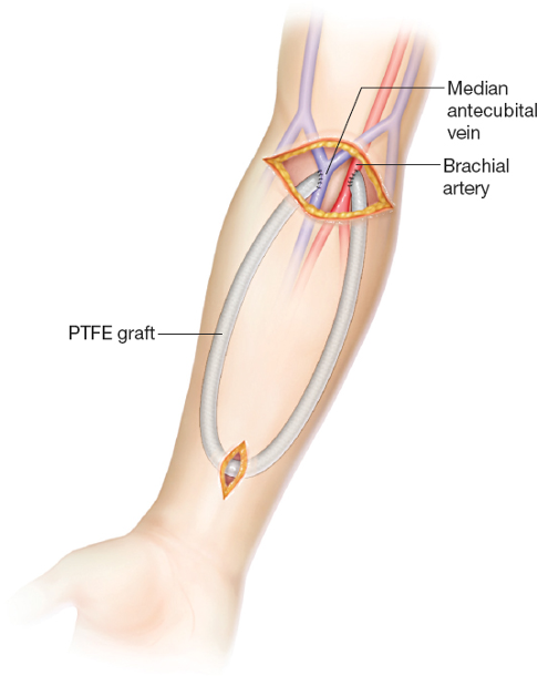 Arteriovenous Graft (AVG)