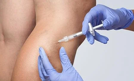 Sclerotherapy (injections)