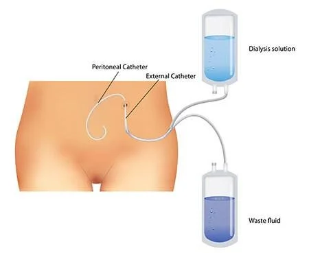Peritoneal Dialysis Catheter (PD)