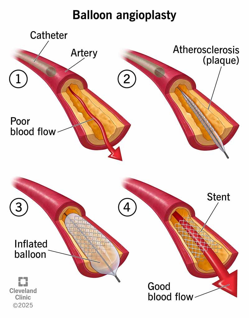 Angioplasty and stenting