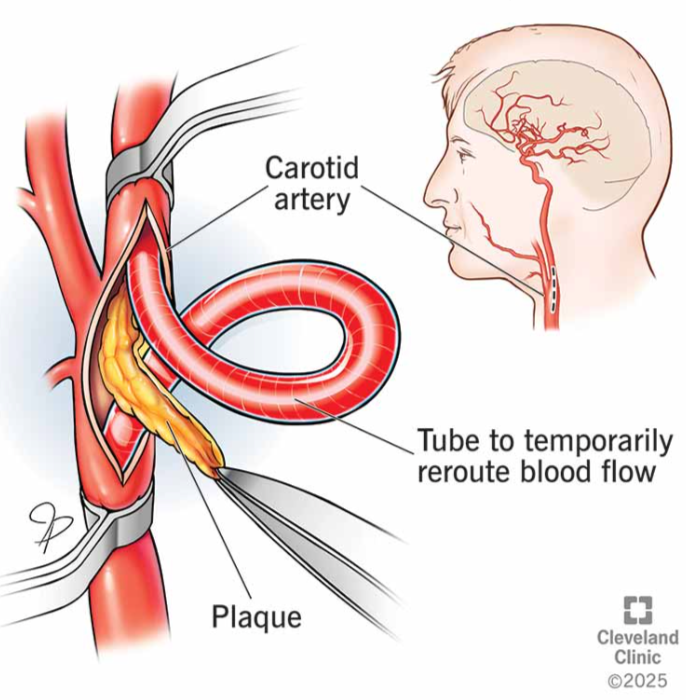 Carotid endarterectomy