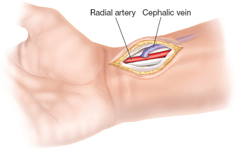 ARTERIOVENOUS FISTULA AVF