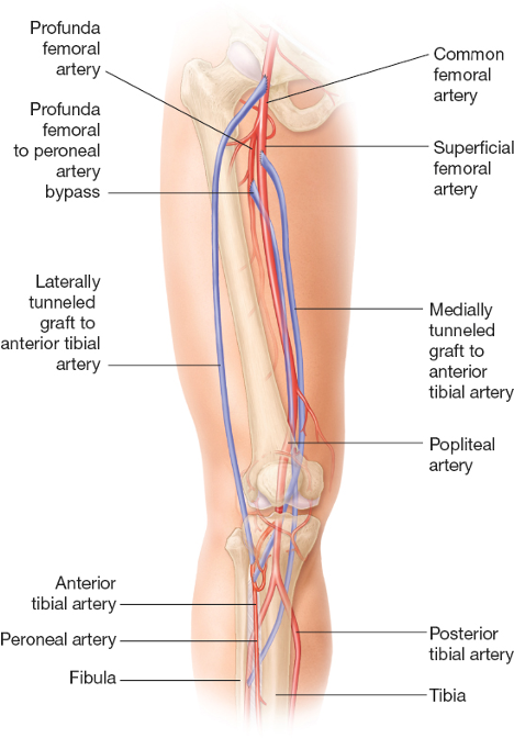 Peripheral artery bypass