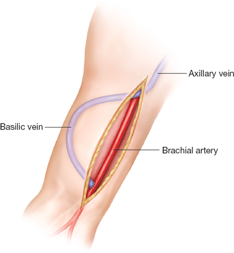 Vein transposition bypass