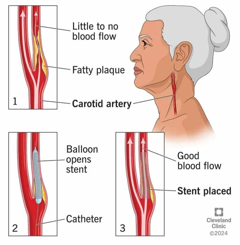 Carotid artery stenting
