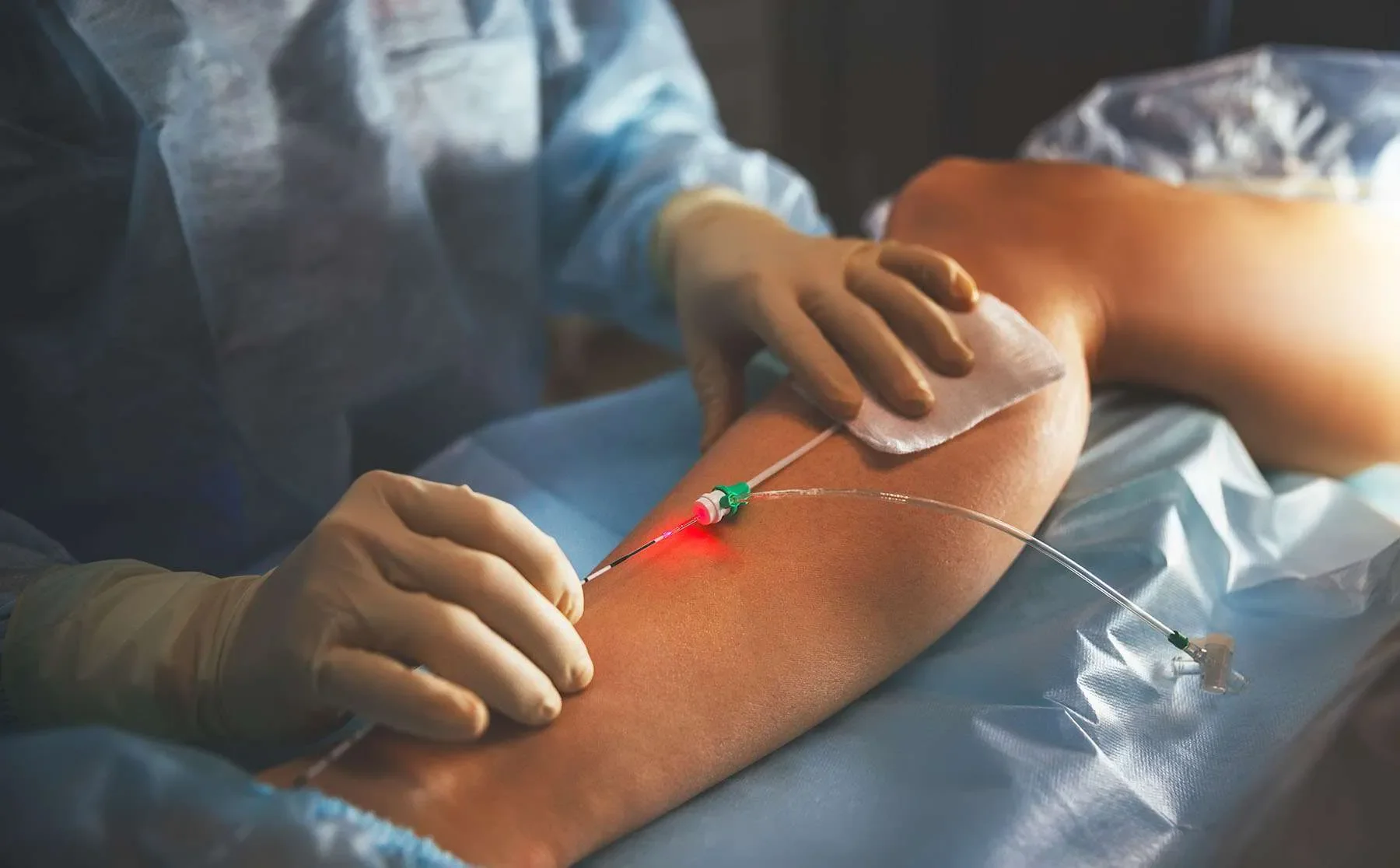 Endovenous ablation (ELVA/RFA)