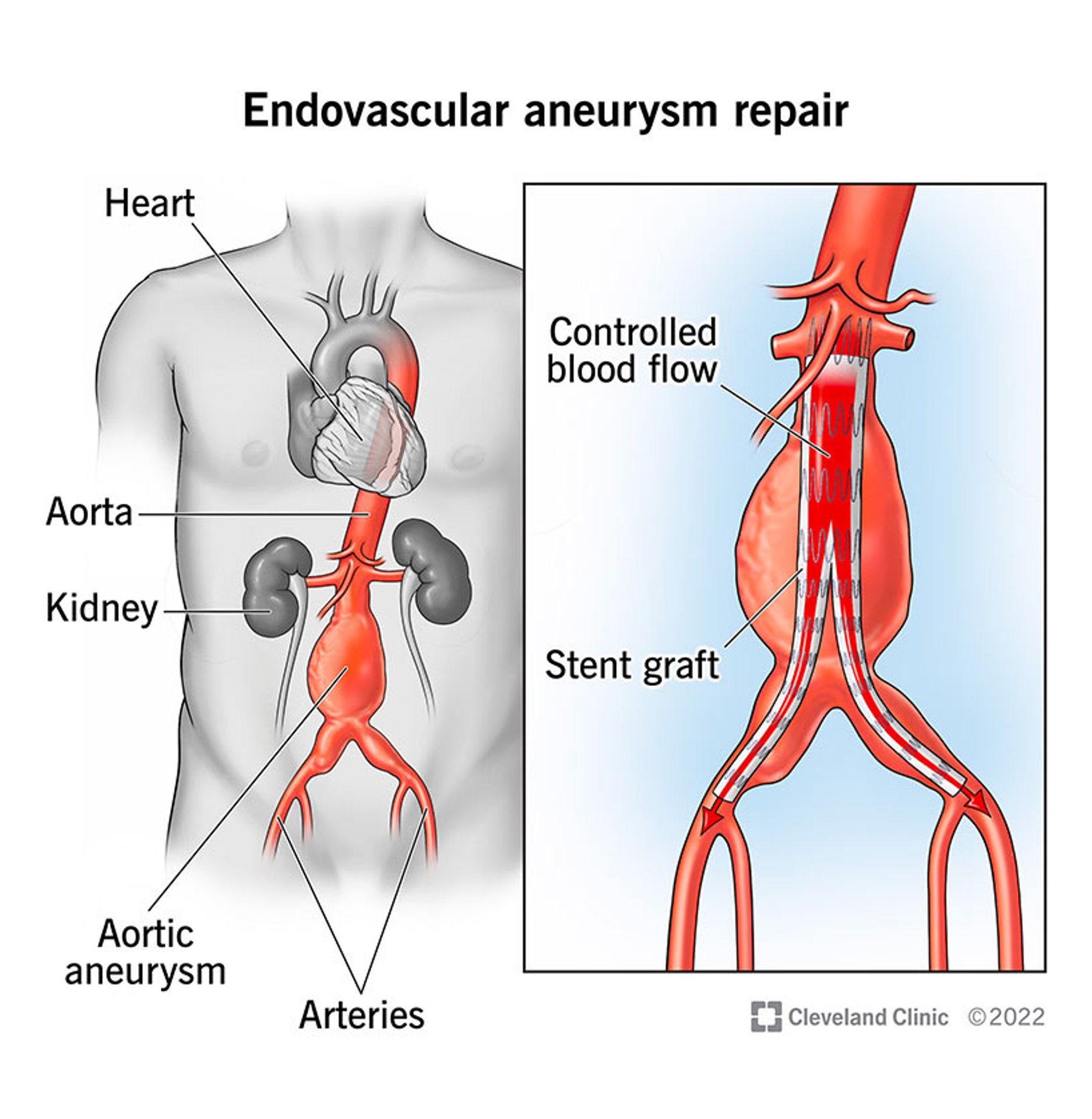 Endovascular Abdominal Aortic Repair (EVAR)
