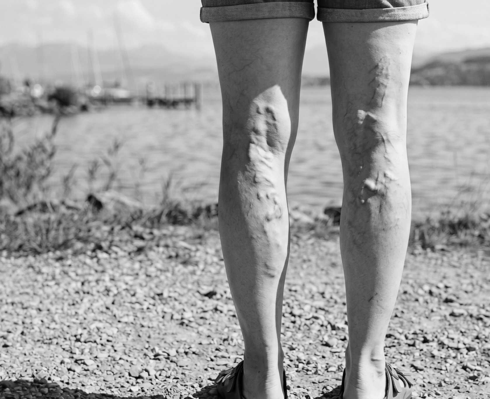 Varicose veins