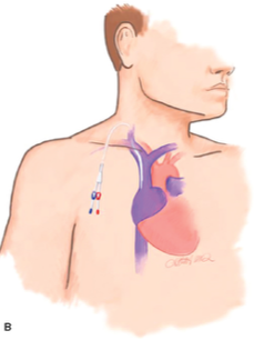 Dialysis catheter (central line)
