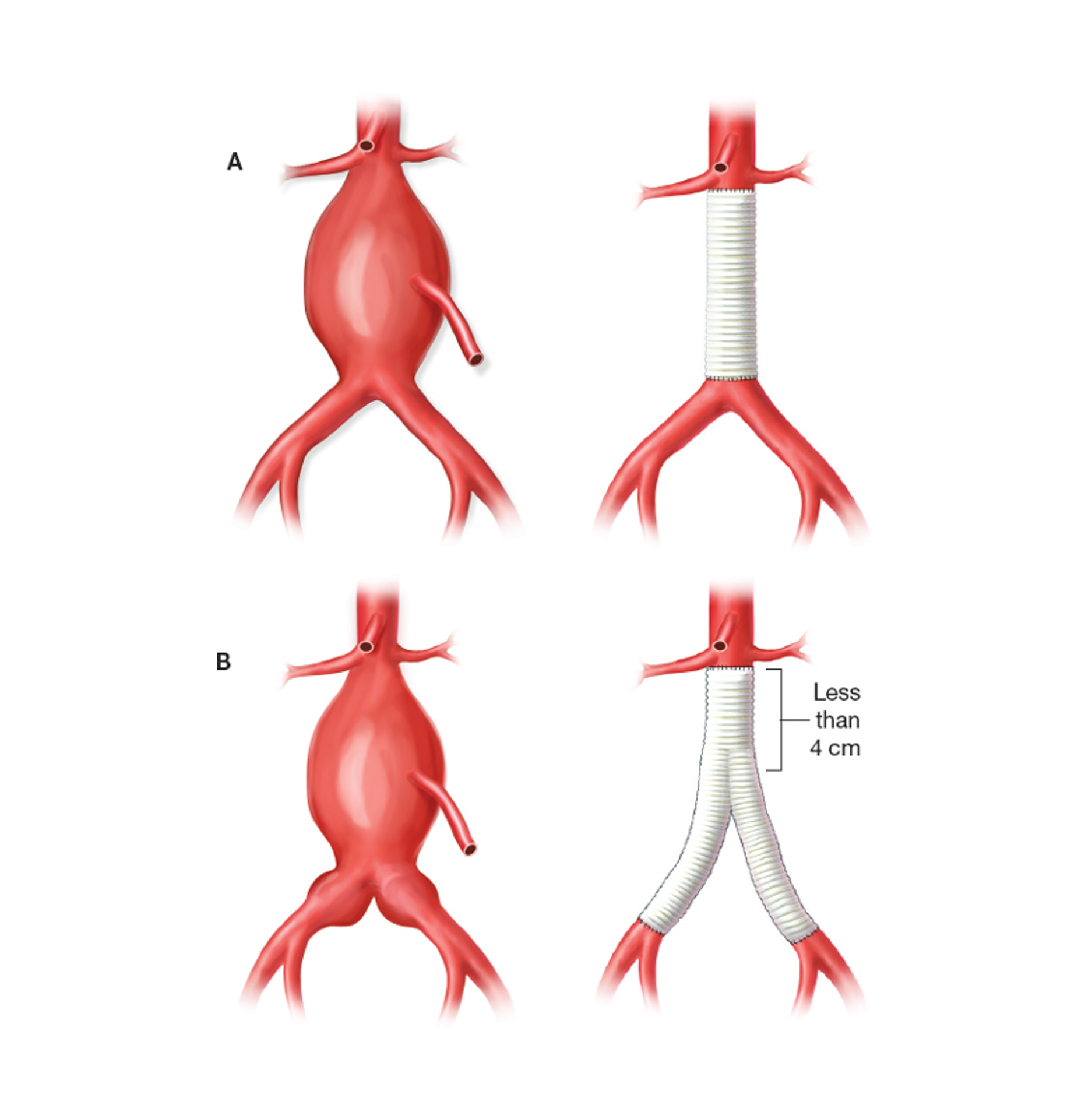 Open Aortic Repair