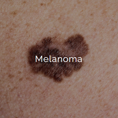 A close-up photo of a skin melanoma mole on skin with the word 'Melanoma' written across it.