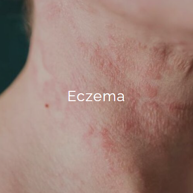 Close-up of a person's neck showing red, inflamed eczema skin with patches of dryness.