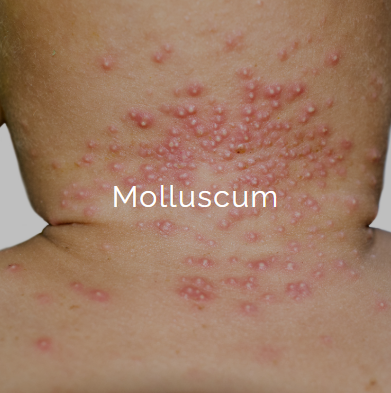 Close-up of a person's neck and upper back with multiple red, raised bumps indicating molluscum contagiosum.