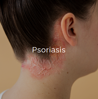 Back of neck with psoriasis causing red, scaly patches
