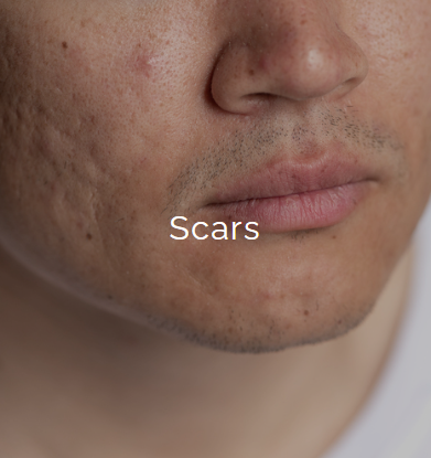 Close-up of a person's face with visible scars and skin imperfections.