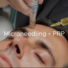A person receiving a microneedling treatment with a device on their face, alongside PRP serum.