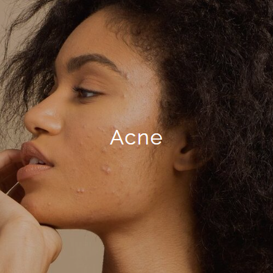 Side profile of a woman with acne on her cheek and chin.