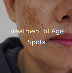 Close-up of a person's face showing age spots, with overlaid text 'Treatment of Age Spots' and part of their nose and lips visible.