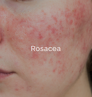 Close-up of a person's cheek showing redness and inflamed skin typical of rosacea.