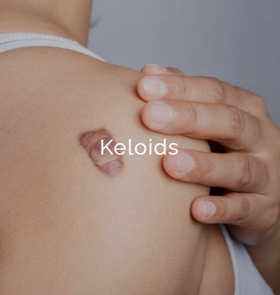 Close-up of a person's shoulder with a raised, irregularly shaped mole.