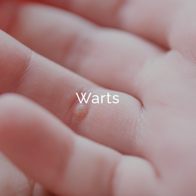 Close-up of a person's finger with a visible wart labeled 'Warts'