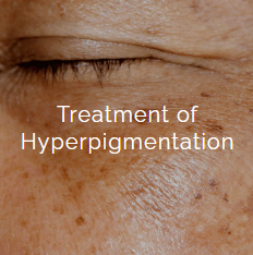 Close-up of a person's closed eye with hyperpigmentation and text overlay that reads 'Treatment of Hyperpigmentation'.
