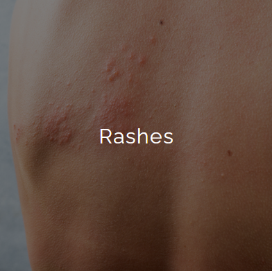 Close-up of skin with reddish bumps and scars, labeled 'Rashes'.