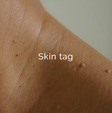 Close-up of skin with small skin tags on the face or neck.