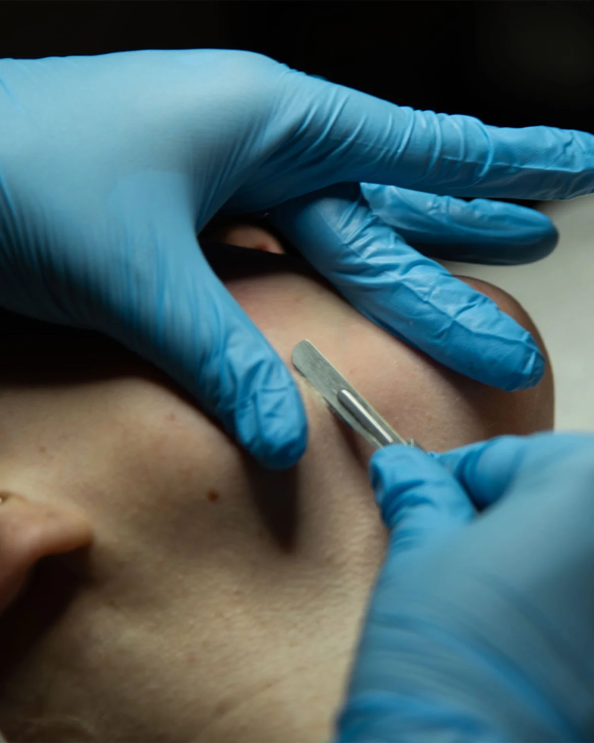 A person receiving a cosmetic or medical treatment on their face, with a healthcare professional wearing blue gloves using a small metal tool near the skin.