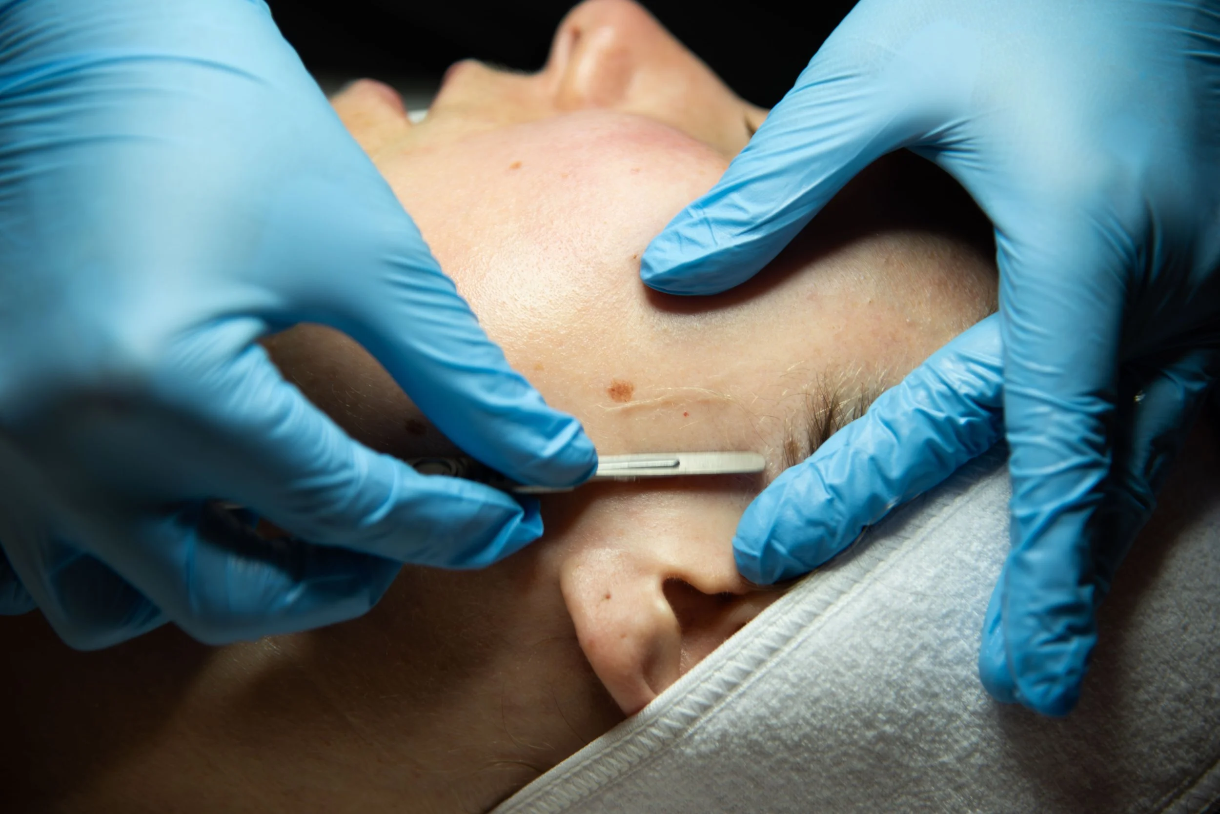 A person receiving a cosmetic or medical procedure on their forehead, with a small tool and gloved hands performing the treatment.